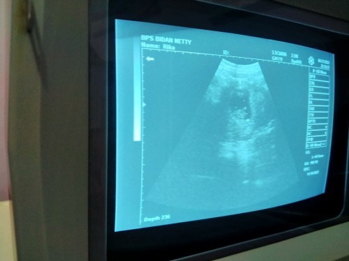 10w 1d apakah sudah ada detak jantung?