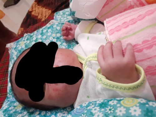 Ruam pipi newborn