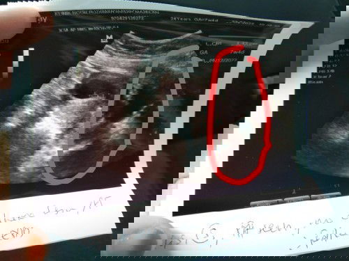 Kantung firstime scan