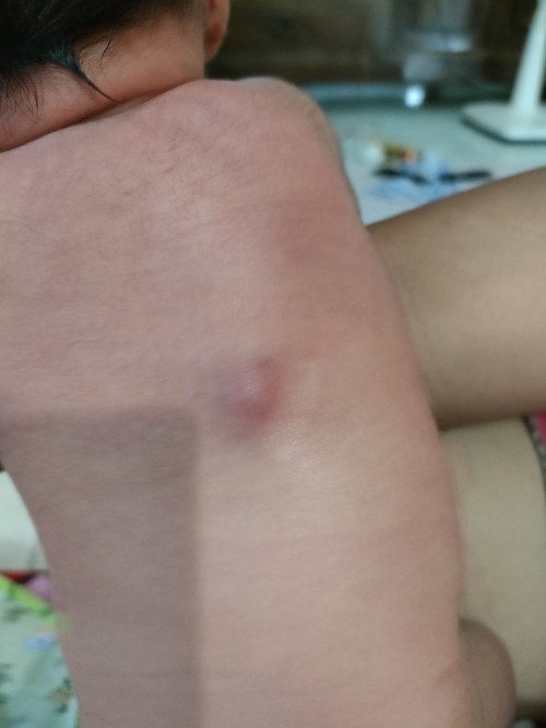 Bentolan dipunggung bayi