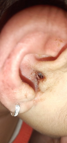 Hello po, bkt po kaya ngka ganto ear ni baby? May same case po b sa baby nyo?
Maya po check up nmin