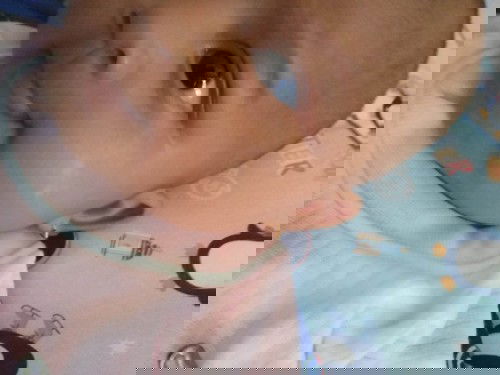 Bekas luka apakah bisa hilang