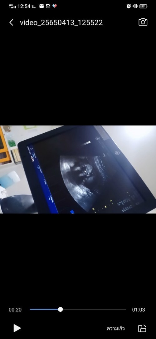 วันนี้ลุงหมอนัด ANC ได้เห็นหน้าชัดมากเลย มีอ้าปากโชว์ไป 1 👶😂