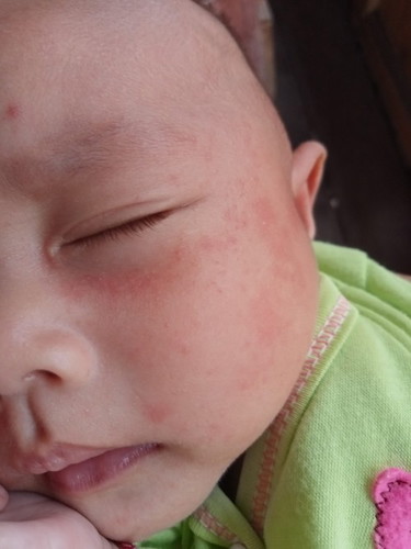 Wajah anak merah merah