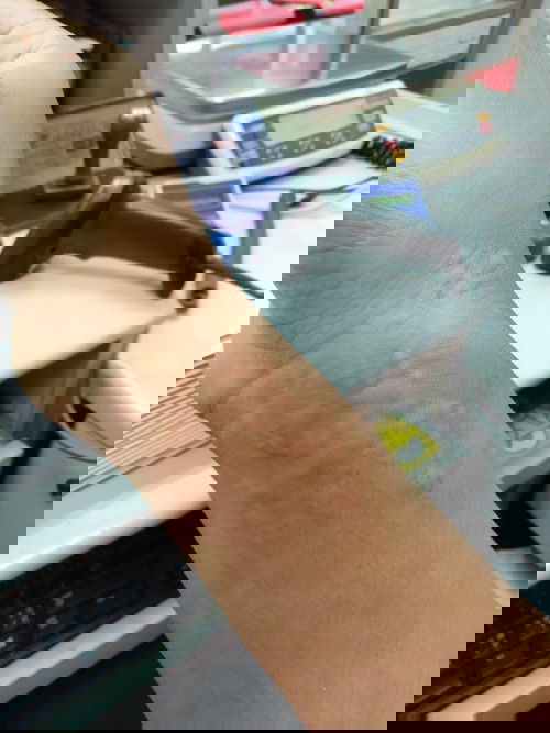 ผื่นคันตอนท้อง