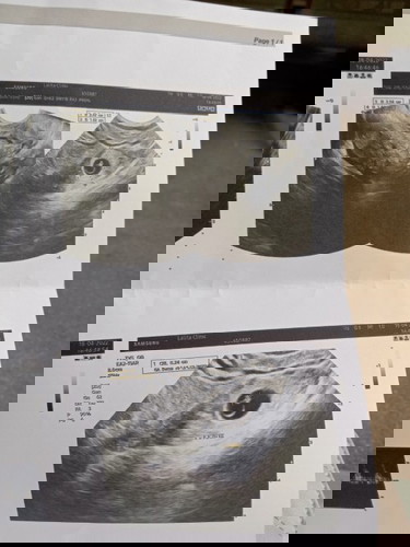 ท้องนอกมดลูก