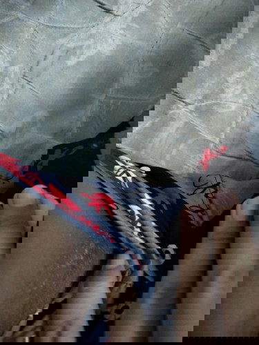 ผดหลังคลอด