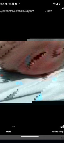 May puting parang laman sa gilid ng mata ng new born baby ko