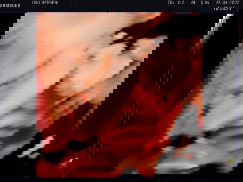 27w kepala bayi di atas/sungsang