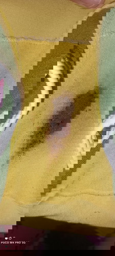 7weeks pregnant my sunchronic hemorrhage my darkbrown spotting