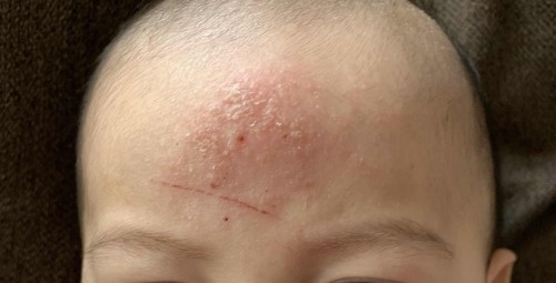 Mga mommy ano po kaya pwedeng pangtanggal dito? Makati po sya lagi kinakamot ni baby. Bibinyagan pa naman sya nextweek 😔