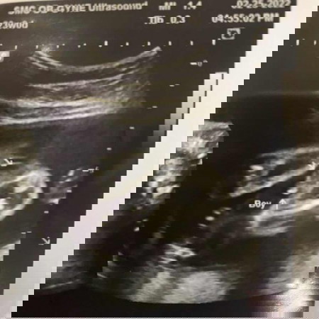 Gender ultrasound