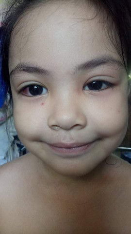 Eye infection anong gamot