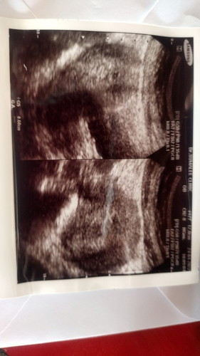 ท้องอ่อนๆ วันนี้มีอาการหน่วงท้อง แล้วมีเลือดออกนับอายุครรภ์ตอนนี้ได้ประมาณ6wไปหาหมอคลีนิคซาวด์ดูหมอ