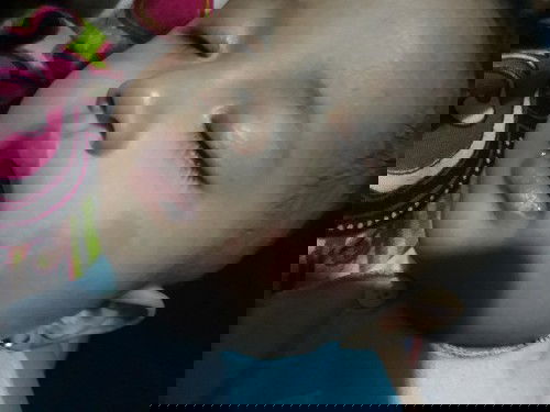 Ruam merad di pipi dan badan