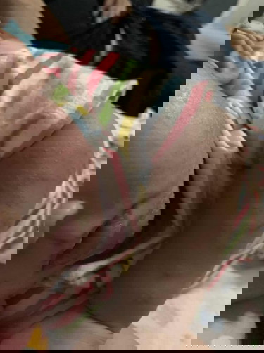 ผื่นขึ้นหน้ากับแขน