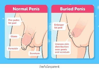 Buried penis sa baby boys and toddlers