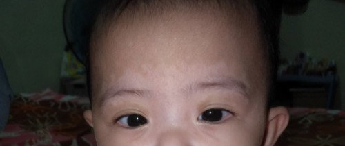 Bercak putih di wajah bayi (pytiarisis alba)