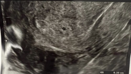 First Pregnancy Scan