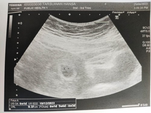 ฝากครรภ์6w1d