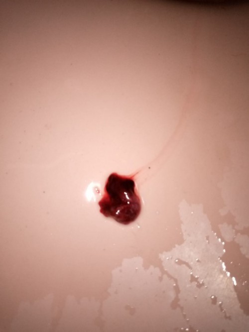 Gumpalan darah Coklat