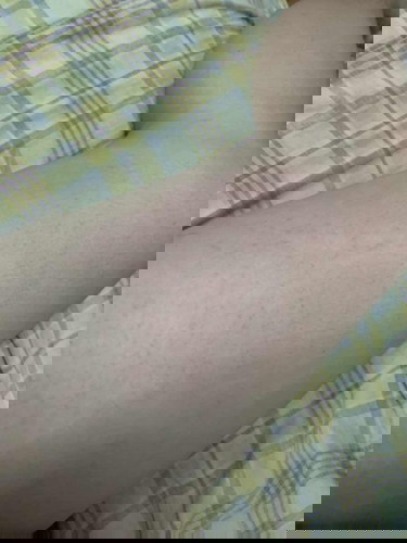 ผื่นคันขึ้นเต็มตัว 🥺 แม่ๆท่านไหนเป็นบ้างคะ?
อันตรายไหมคะ?