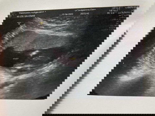 เพศของลูก ท้องแรก