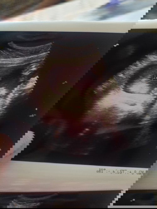 Hello po ano po sa tingin nyo ang gender ni baby boy or girl❤️