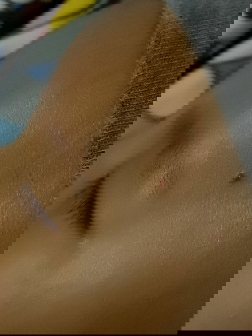 Bayi bintik merah berdarah