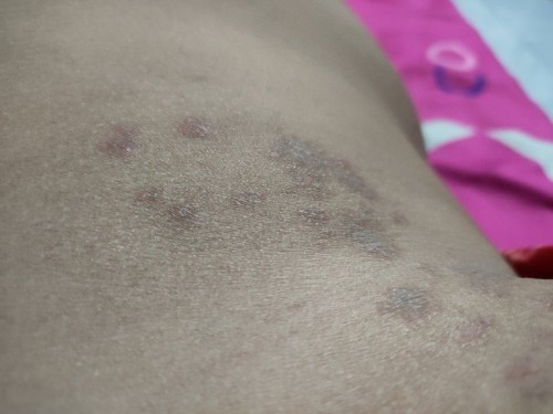 Tentang gatall kulit