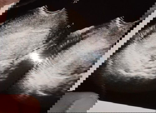 Kantong janin belum terlihat testpack positif