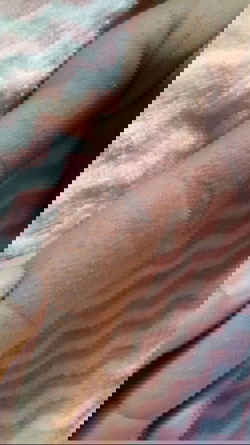 Bruntusan atau alergi?