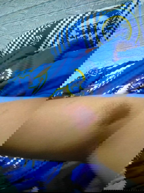 Tangan memar sesudah di ambil darah