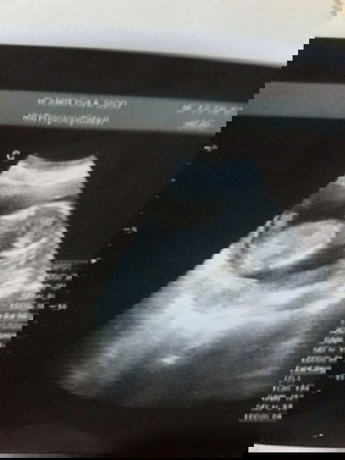 Hamil 16 week 5 day sudah mulai sakit punggung