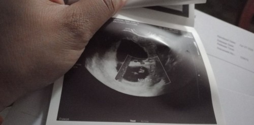 10weeks pero walang heartbeat .. may chance pa ba? π