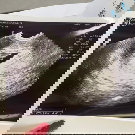 7 weeks preg cant see the baby but can hear the heartbeat. Is it normal?🥺