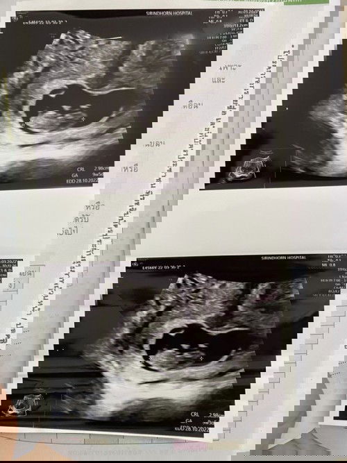 พาหะธารัสซีเมีย