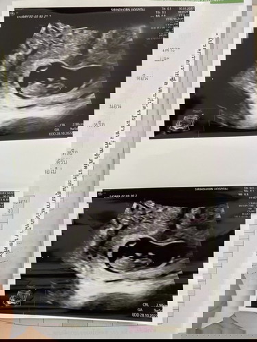 พาหะธารัสซีเมีย