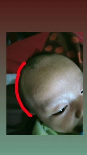 Kepala bayi seperti ada bando