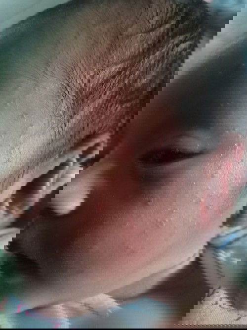 Bintik merah pada baby