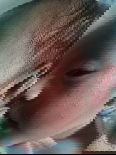 Bintik merah pada baby