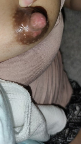 Redness under nipple
