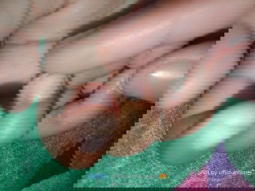 Bentol padat bening di sela jari