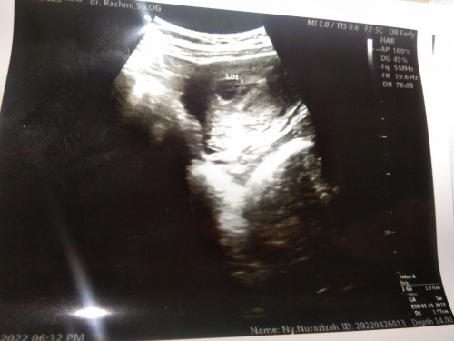 Mau tnya ini cara baca usgnya gmna ya, dan uda hamil brpa minggu, krna gk smpt tanya dokter kmrenπ