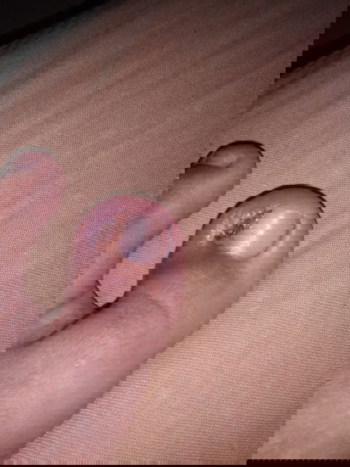 Cantengan berbulan bulan