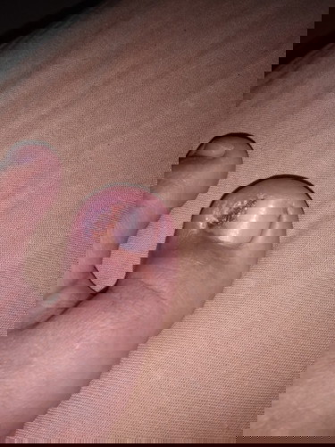 Cantengan berbulan bulan