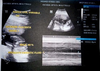 Hello po mga momshie 🥰
Matanung lang po,baby boy or girl kaya?