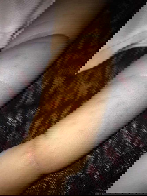 Cara menghilangkan bekas gigitan nyamuk