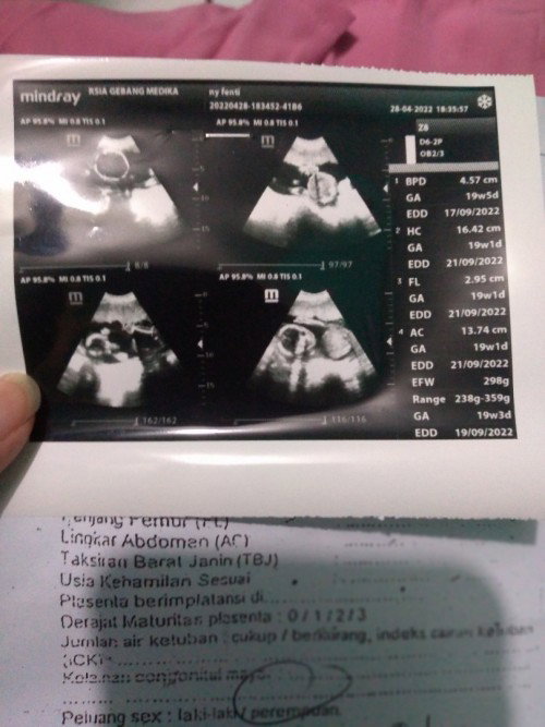 Hasil usg pertamaku bun dri awal hamil