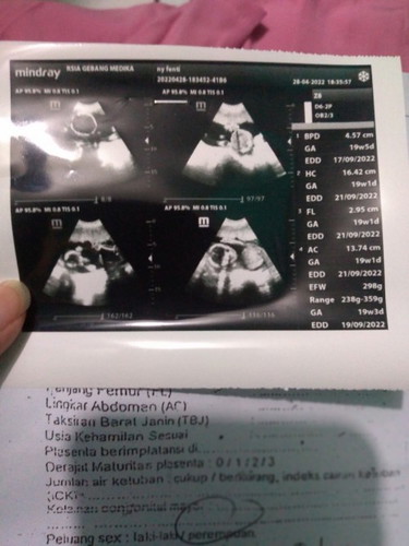 Hasil usg pertamaku bun dri awal hamil